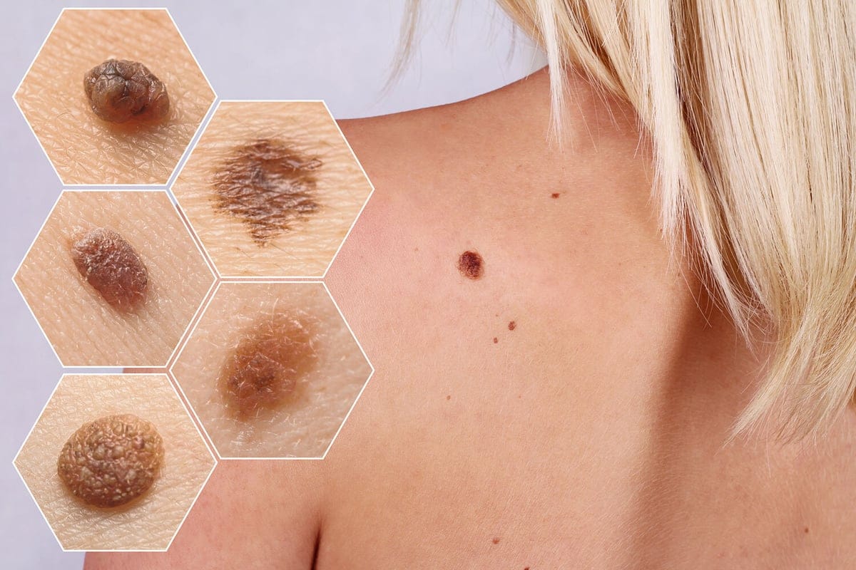 Skin Carcer detection new process